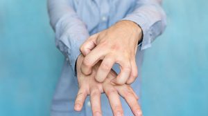 Wieder einmal steigende Krätze- und HIV-Fallzahlen infolge der Massenflucht Wieder einmal steigende Krätze- und HIV-Fallzahlen infolge der Massenflucht